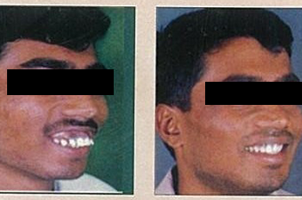 jaw corrective treatment