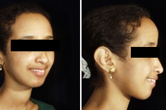 jaw corrective treatment