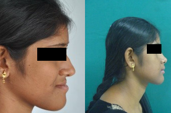 jaw corrective treatment