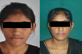 jaw corrective treatment