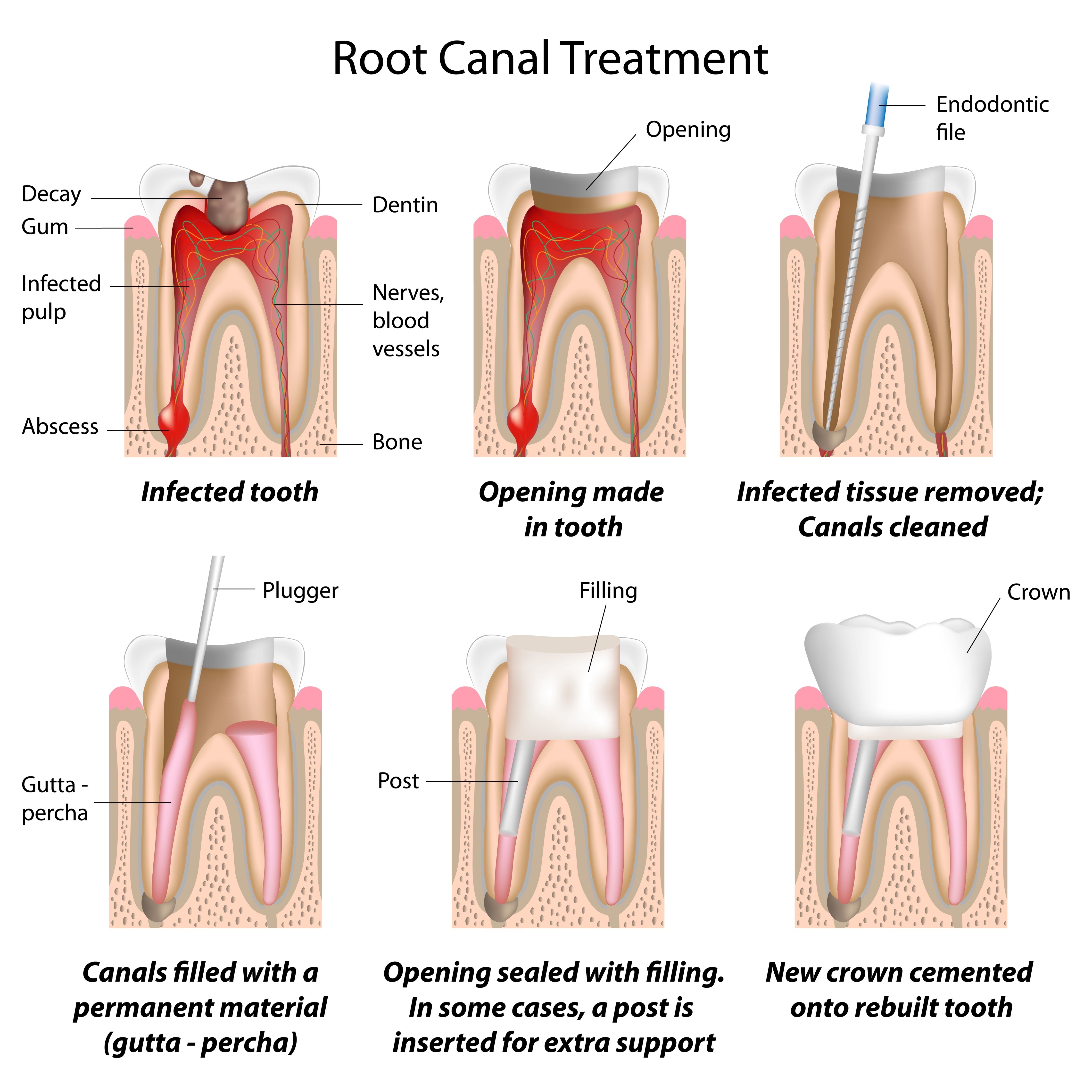 root canal treatment in Guntur