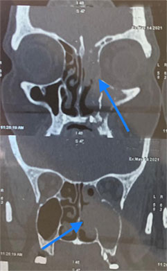 black-fungus-post-covid-mucormycosis