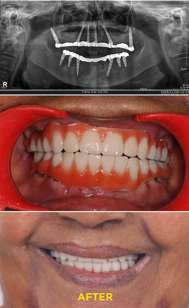 Confydentz Tilted Implants ; All on X case reports