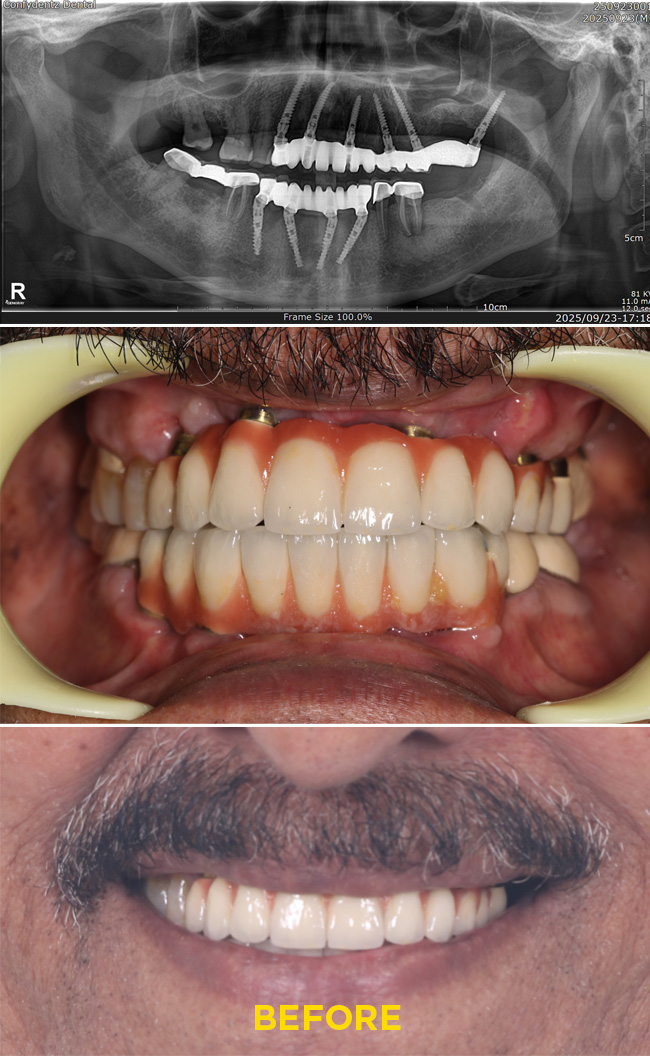 Confydentz Tilted Implants ; All on X case reports