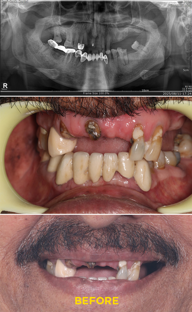 Confydentz Tilted Implants ; All on X case reports