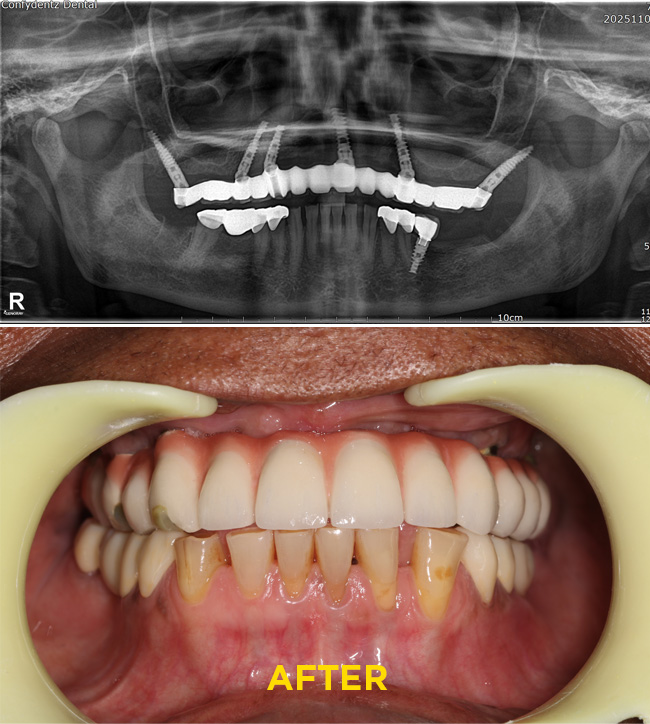 Confydentz Tilted Implants ; All on X case reports
