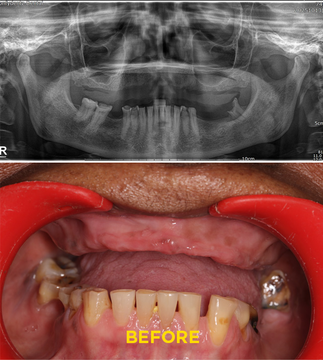 Confydentz Tilted Implants ; All on X case reports