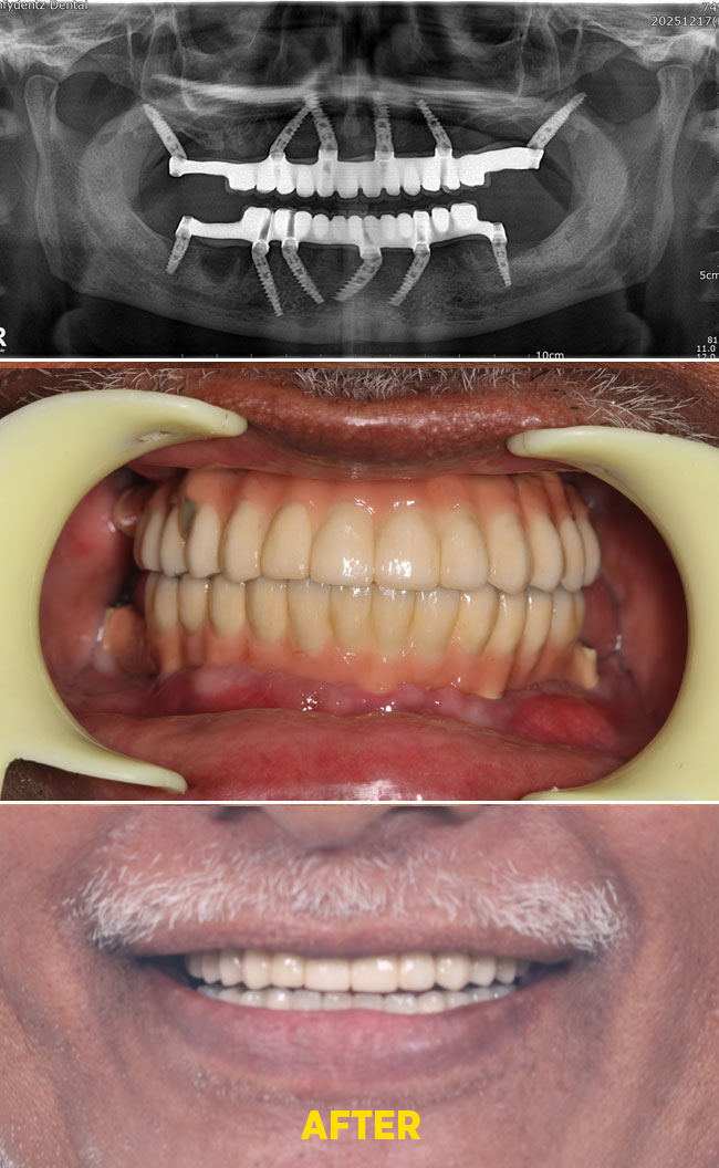 Confydentz Tilted Implants ; All on X case reports
