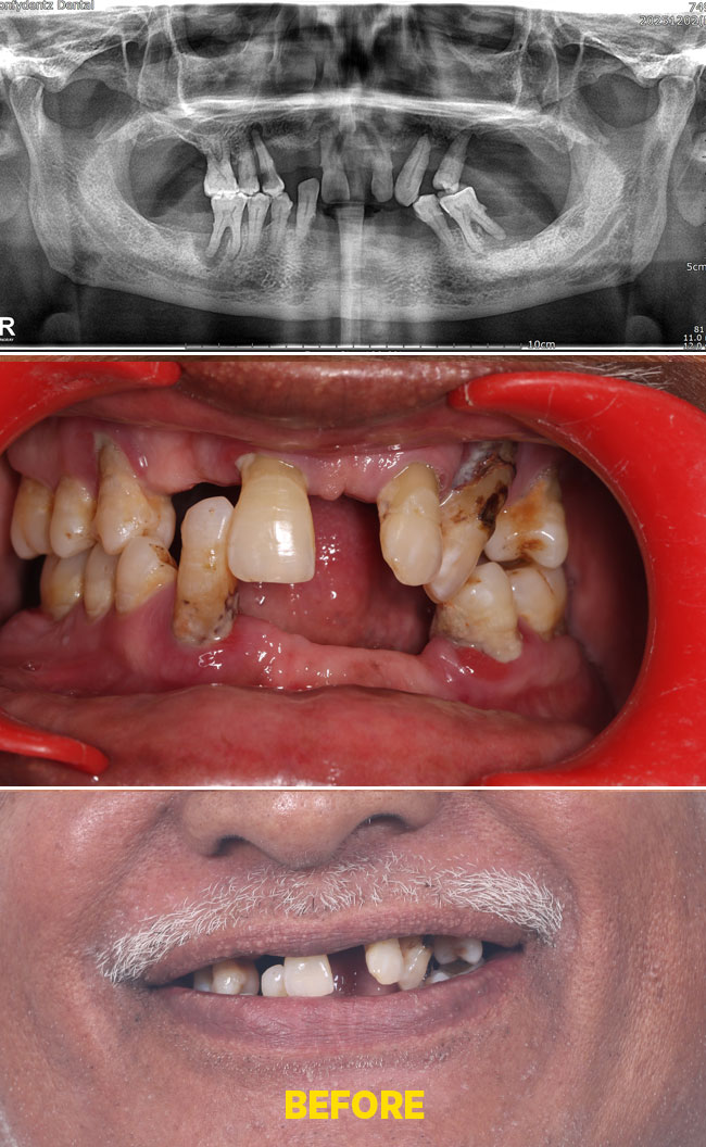 Confydentz Tilted Implants ; All on X case reports
