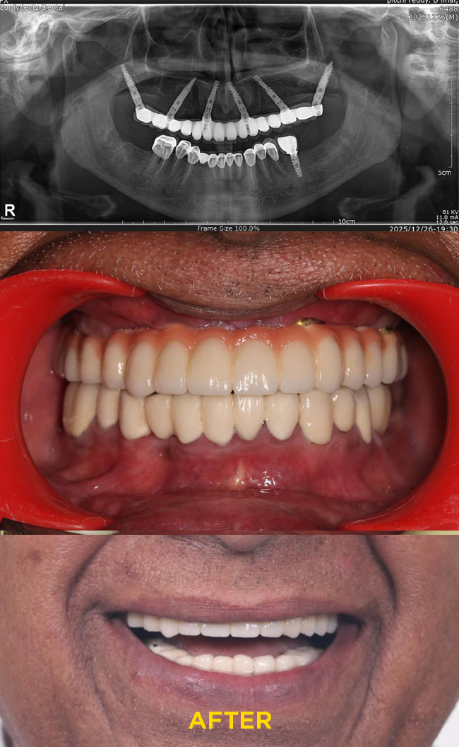 Confydentz Tilted Implants ; All on X case reports