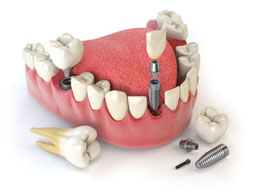 dental implants