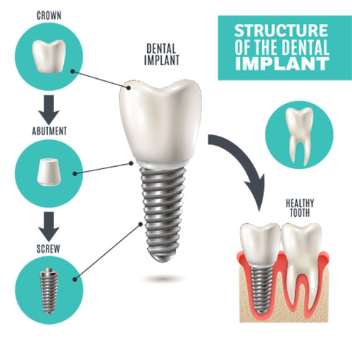 dental implants