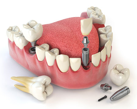 dental implants in Guntur