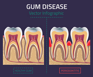 Gum disease treatment in Guntur