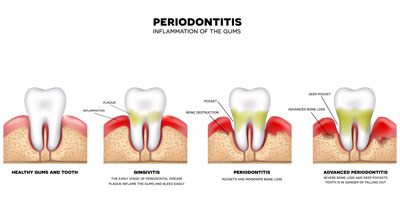 gum disease treatment in Guntur