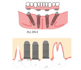 dental implants in guntur