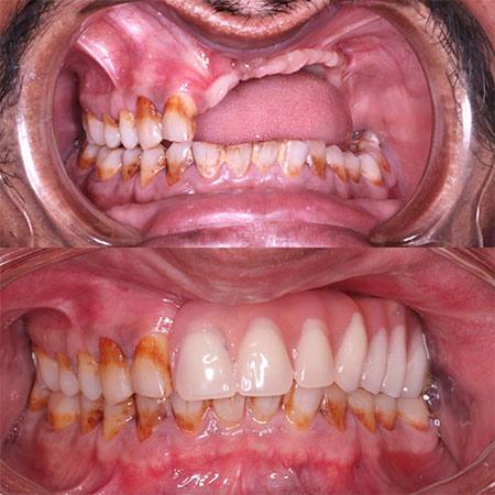 Replacement of Fixed teeth