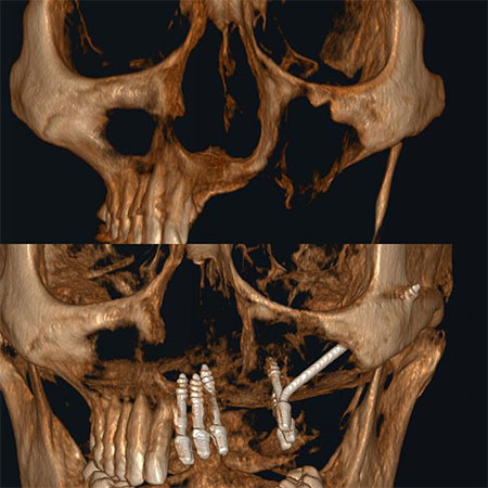 Replacement of Fixed teeth