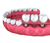 multiple tooth replacement in guntur