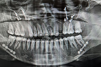Oral Maxillofacial surgeryin guntur