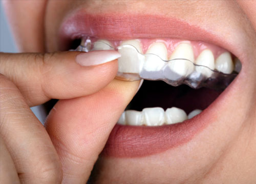 Black Fungus Mucormycosis