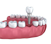 single tooth replacement in guntur