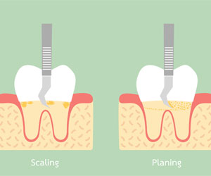 laser treatment in AP