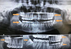 Wisdom Teeth