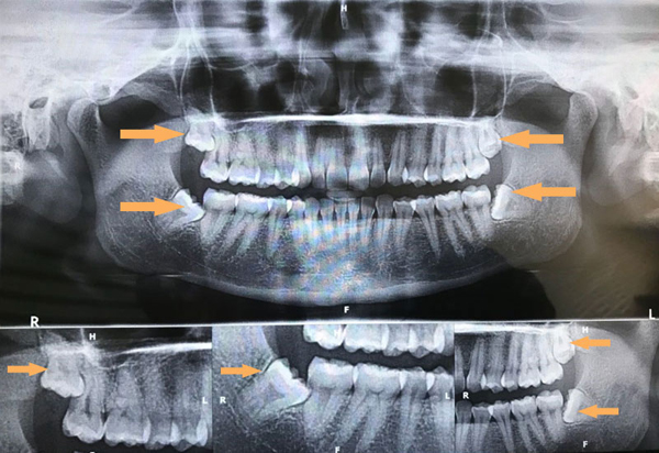 dental implants